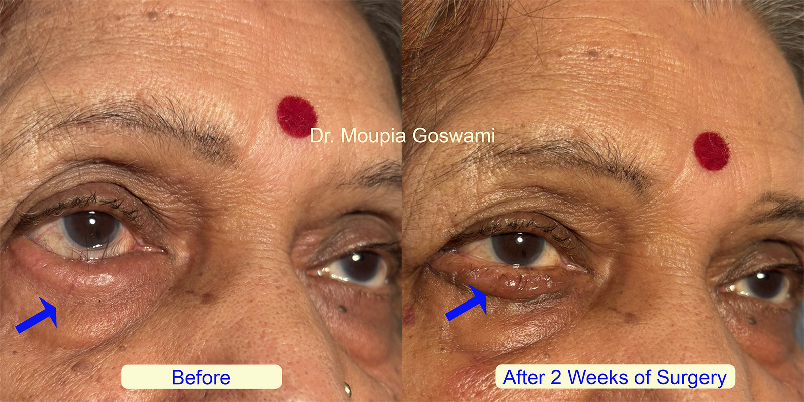Entropion Surgery Before and After - Case 4
